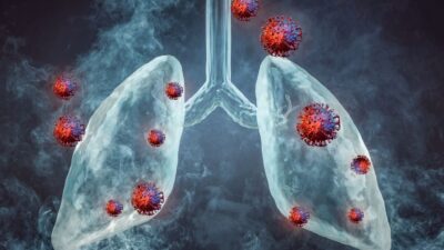 Bronquite: tipos, sintomas e tratamentos