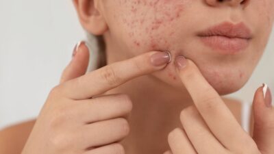 Como acabar com espinhas: Tratamentos eficazes para uma pele limpa