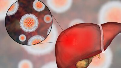 Hepatite C: Transmissão, sintomas e tratamentos