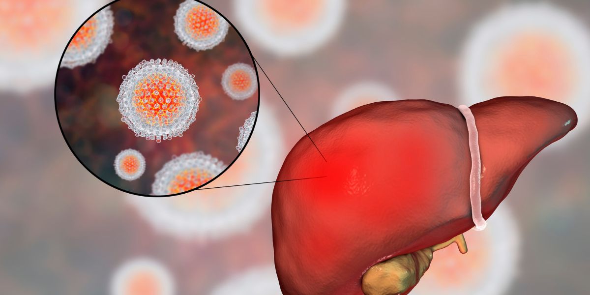 Hepatite C: Transmissão, sintomas e tratamentos