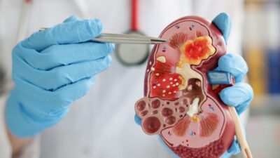 Pedra nos rins: Sintomas, como eliminar cálculos renais e prevenir novos