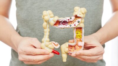 Prisão de ventre: Causas e 5 dicas para aliviar a constipação