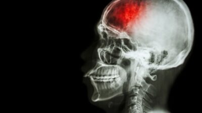 Sintomas de AVC: Identifique um derrame e busque socorro imediato