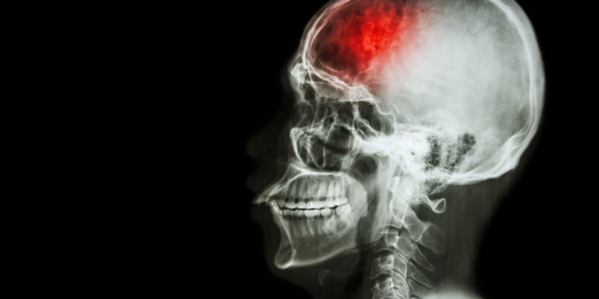 Sintomas de AVC: Identifique um derrame e busque socorro imediato