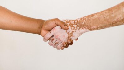 Vitiligo: O que é, tratamentos disponíveis e cuidados com a pele